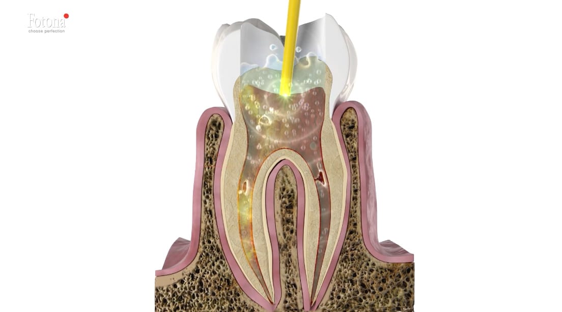 Fotona Laser image